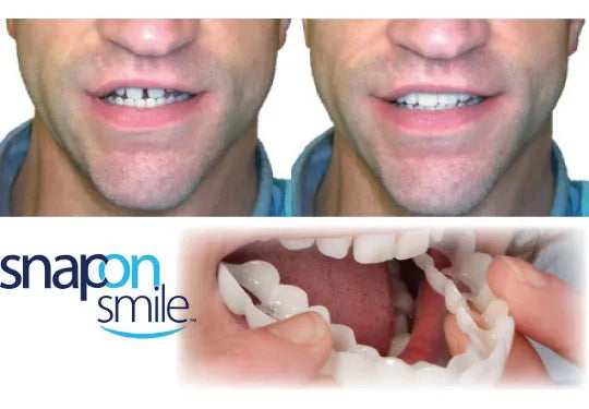 Carilla Dental Estética Snap On Smile